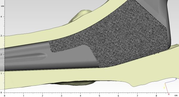 Model Tibijalnog Implanta za zamenu kukova - Image 4