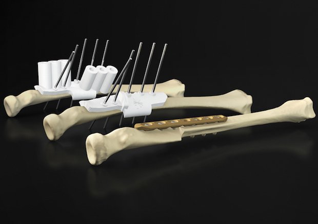 Materialise Osteotomy Guides