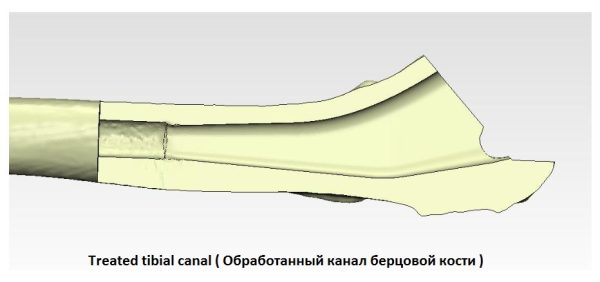 Model Tibijalnog Implanta za zamenu kukova - Image 10
